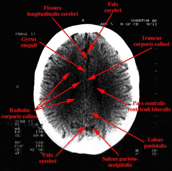 tomografia komputerowa głowy - 12.jpg